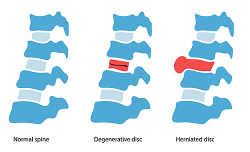 Illustration of spine disease, normal backbone, degenerative disc and herniated disc.